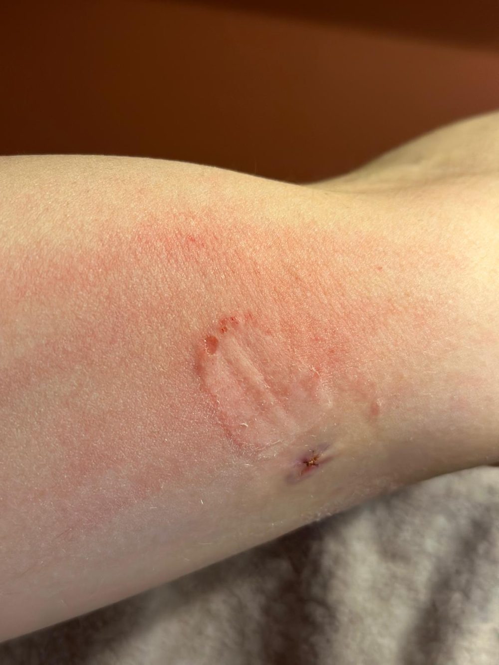 Forearm skin showing a rectangular area where the surface layer has been pulled away, matching the shape of an adhesive bandage.