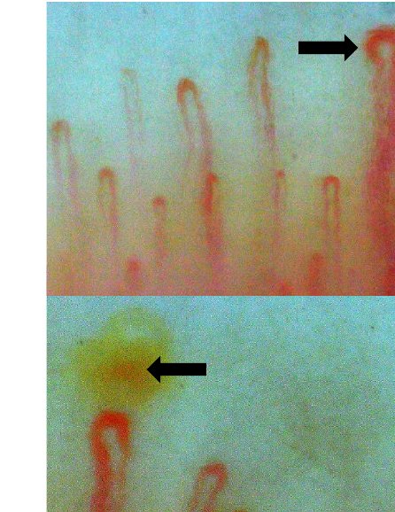 Nailfold capillaroscopy images at high magnification showing capillary loops with areas of haemorrhage and dark spots.