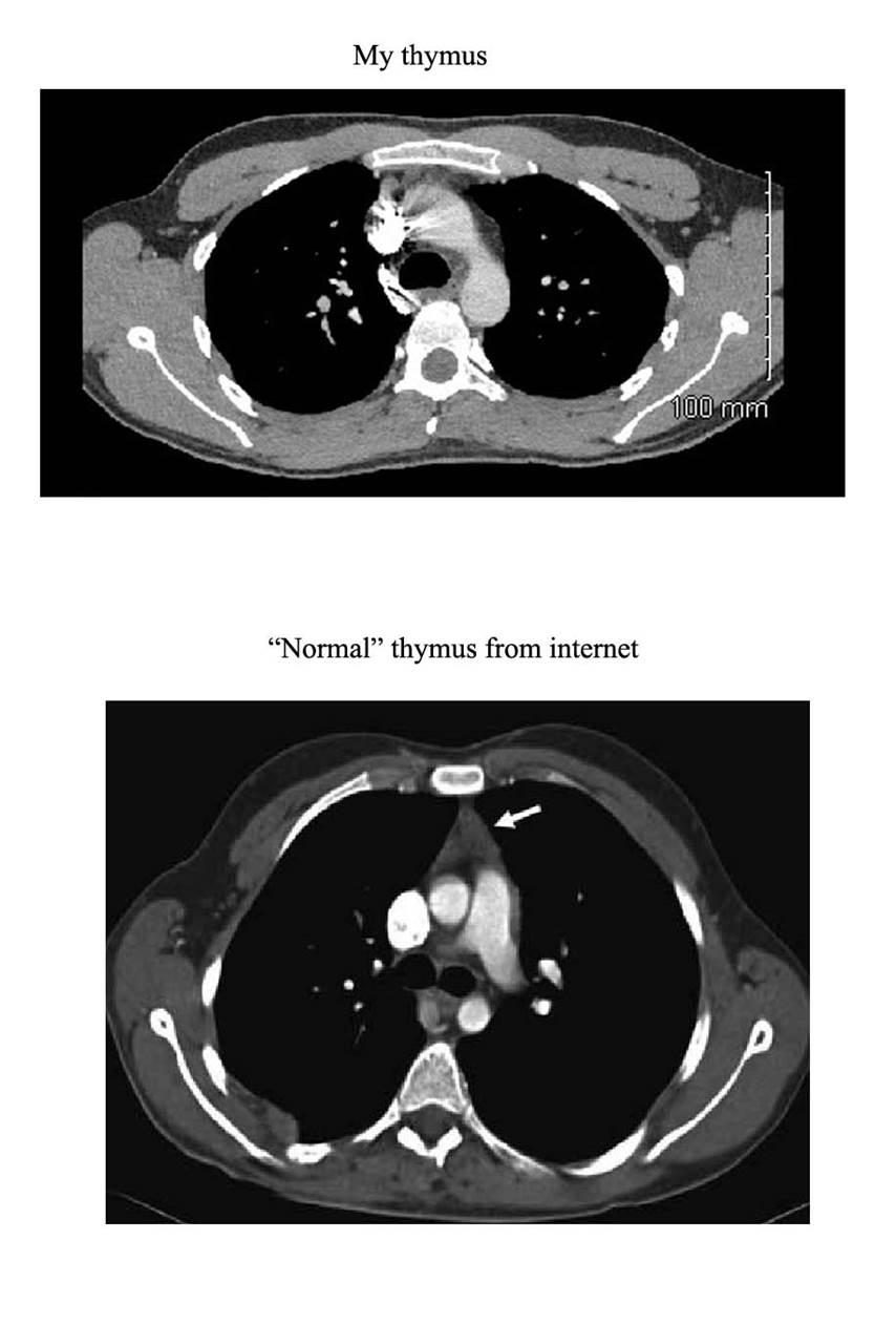 Two axial chest CT slices side by side. The upper image is the subject's scan, showing a compressed retrosternal space; the lower is a comparison scan with an arrow marking normal thymic tissue.