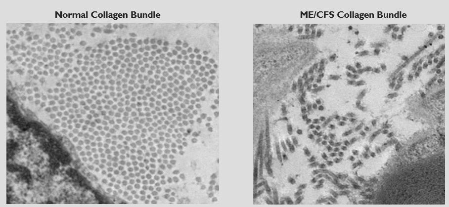 Two electron micrographs compared: a normal collagen bundle showing evenly packed fibrils in cross-section, and an ME/CFS collagen bundle showing scattered, disorganised fibrils.