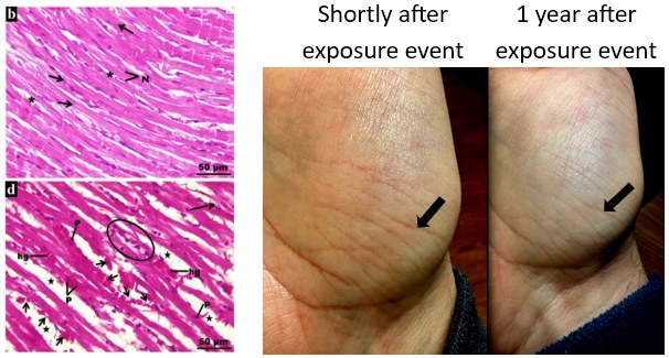 A four-panel composite: two histology panels on the left showing separated, disorganised muscle fibres in rat heart tissue after titanium dioxide exposure; two photos of the same wrist on the right, shortly after and one year after a suspected titanium dioxide exposure, showing faint skin striations.