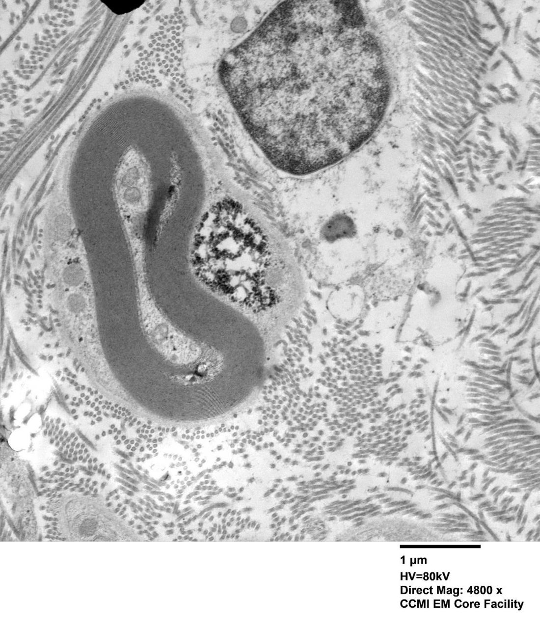 Transmission electron micrograph of a myelinated peripheral nerve, with a dense cluster of dark granules and pale clumps in the surrounding Schwann cell cytoplasm.